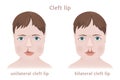 Congenital childhood pathology cleft lip.